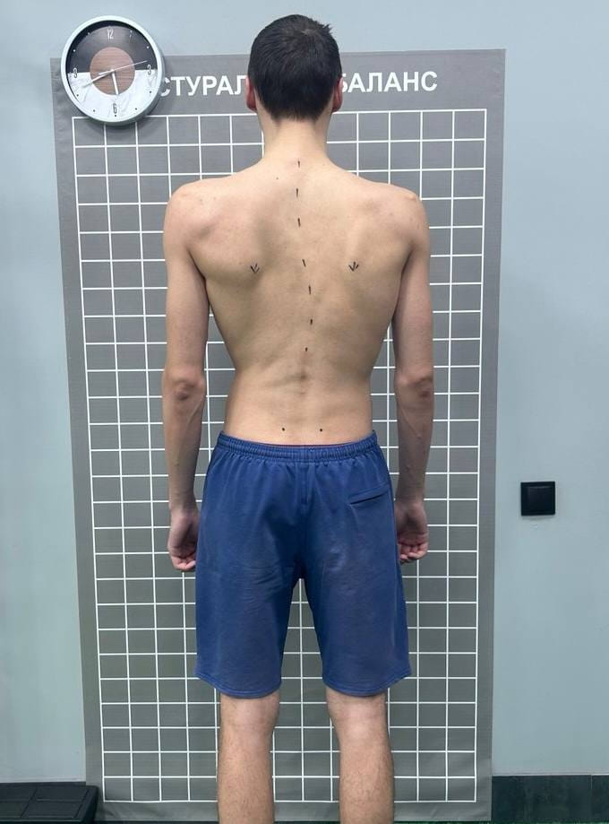 Лечебный массаж при сколиозе